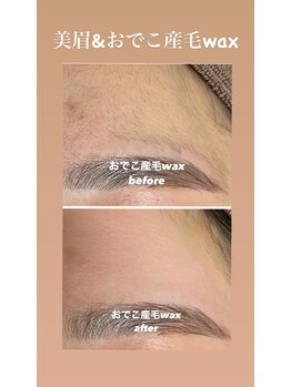 アデージョ(Adejio)/おでこのパーツワックス脱毛