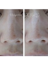 ドブレ(DOBRE)/毛穴洗浄