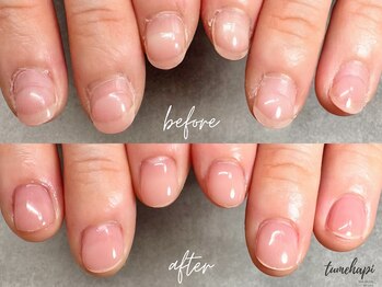 4週後のフィルイン施術