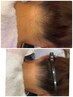 【女性専用部分脱毛】¥2200
