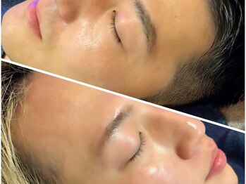 オプス ライフビューティー(OPS×LIFE BEAUTY)/ひげLED脱毛