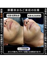 メンズディースタイル 北谷店(Men's Dstyle)/北谷メンズ脱毛ヒゲBefore after