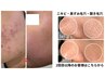【再来／肌質改善メンテナンス】剥離なしハーブピーリング