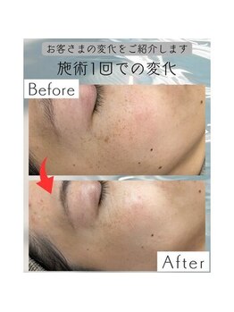 コリー(Kolly)/シミケアとは？