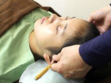 いなほ はりきゅう整骨院 東新宿/美容鍼施術/手順11