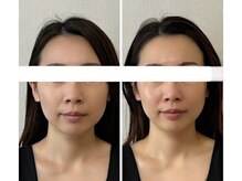 メディカルエース(MedicalAce)/【最強引き上げ】ハイサーマ