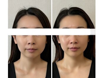 メディカルエース(MedicalAce)/【最強引き上げ】ハイサーマ