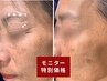 【モニターでお得！】◇ニキビ後ケア・シワ・凹凸にお悩みの方へ