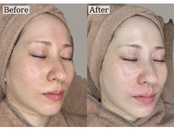 あすはれ/感動するほどの肌変化ララピール