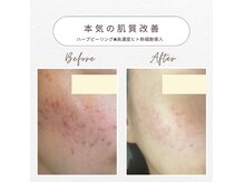 スキンベイビー 池袋店(Skin Baby)の雰囲気（ヒト幹細胞ハーブピーリングで最強肌質改善！美肌へ導きます）