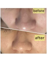 リリースパ 辻堂店(Lily spa)/贅沢泡洗顔1回で毛穴ゴッソリ！