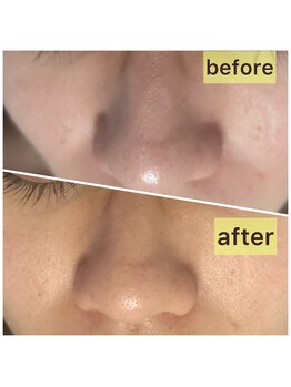 リリースパ 辻堂店(Lily spa)/贅沢泡洗顔1回で毛穴ゴッソリ！