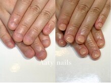 アーティネイルズ(Aaty Nails)/【深爪矯正】ハンド