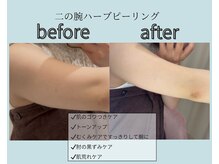 エレナ(ELENA)/二の腕剥離なしハーブピーリング