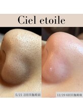 シエルエトワレ/メンズ 毛穴エクストラクション