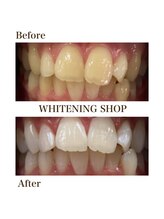 ホワイトニングショップ 大分店/Before&Aftre美白ホワイトニング