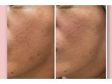 アリュール(Allure)の雰囲気（バクチオールピーリング◆シミ、毛穴、肌荒れでお悩みの方へ！！）