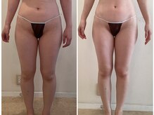 ビューティーマックス(Beauty Max)/痩身　before→after 1.5ヶ月後