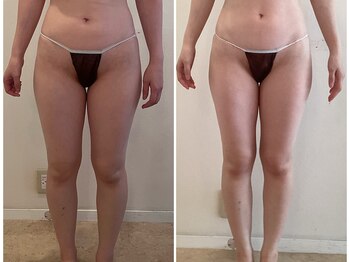 ビューティーマックス(Beauty Max)/痩身　before→after 1.5ヶ月後