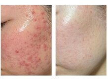 ファニービー 茨木店/20代 Before→After