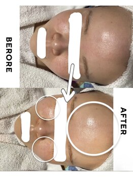 ポノ(PONO)/水光ピーリング