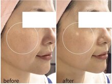 エステティックサロン アールグレー 名古屋駅店/白玉ホワイトスノーピール1回