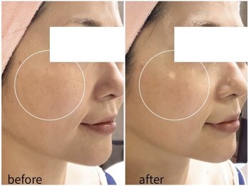 エステティックサロン アールグレー 名古屋駅店/白玉ホワイトスノーピール1回