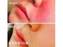 繰り返す肌荒れに終止符を！