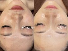 レシェルサロン(Lechelle Salon)/30代肌質改善　ハーブピーリング