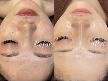 レシェルサロン(Lechelle Salon)/30代肌質改善　ハーブピーリング