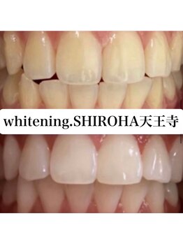 シロハ(SHIROHA)/セルフホワイトニング/天王寺
