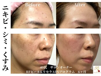 ローズフィールド(Rosefield)/RFピール/ニキビ/シミ/毛穴