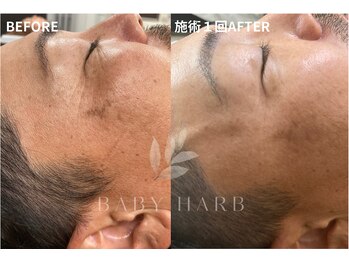 フィズ 経堂店(FIS)/☆ハーブピーリングで美肌に☆