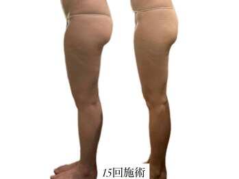 痩身革命 大宮店/ダイエットリンパマッサージ