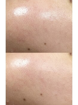 アットウィル 志木店(at will)/超音波ピーリングBefore After