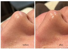 エクリュ(ecru)/毛穴洗浄