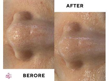 フロー(Flow)/ハーブピーリング