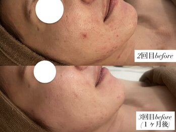 サロンワイアネシス(Salon y ANESIS)/ハーブピーリング