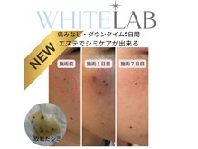 エステで痛みなしのシミケアが新登場