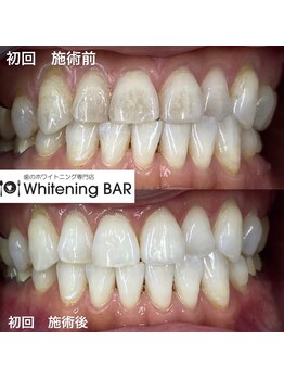 ホワイトニングバー 高崎店/ヤニ汚れも1発解消で大喜び!