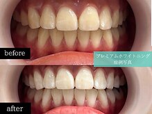ホワイトニングカフェ 博多駅前店(WhiteningCafe)/◎歯のホワイトニング施術写真◎