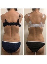 リボディ プラチナ(Rebody platinum)/脂肪冷却×ボディケア