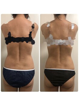 リボディ プラチナ(Rebody platinum)/脂肪冷却×ボディケア