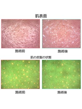 ベベ 目黒店(Be'be')/頬のビフォーアフター