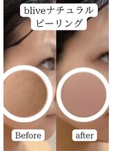 ビライブ 名古屋店(blive) blive ピーリング
