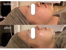 リスタ(RSTA)/【BEFORE/AFTER】