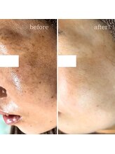 マーギアー(Magier)/ハーブ＋ダーマ　初来店→9回