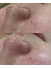 ミュー 自由が丘店(mieux)/◆肌質改善例