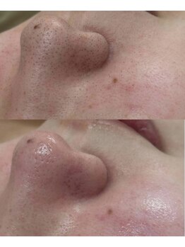 ミュー 自由が丘店(mieux)/◆肌質改善例