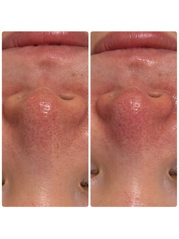 シュガー(Sugar...iyr)/プラズマニア小鼻撃退コース